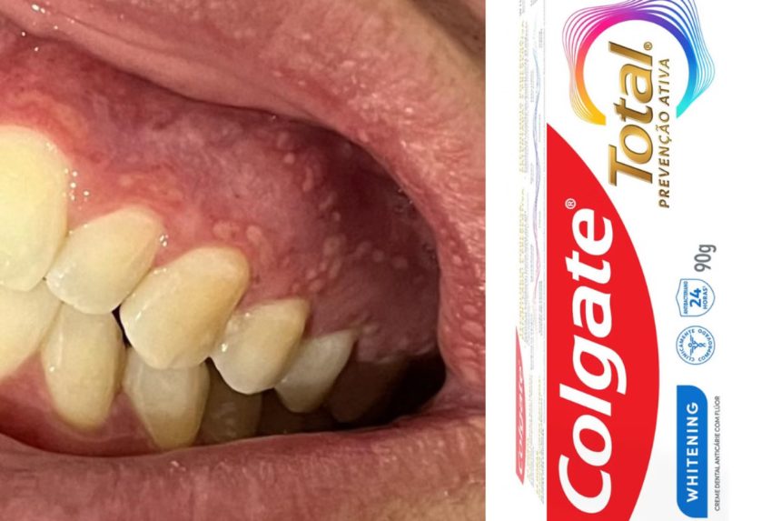 Capa: Anvisa suspende creme dental da Colgate após relatos de reações